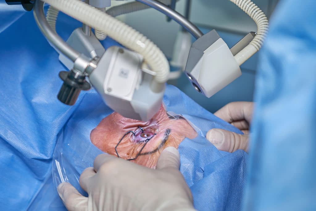 A Complete Guide to Lasik Turkey Price and Packages